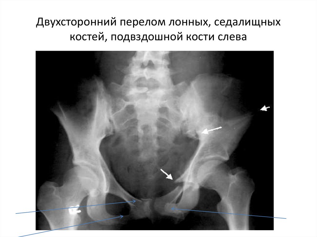 Компенсация дтп перелом лонной кости