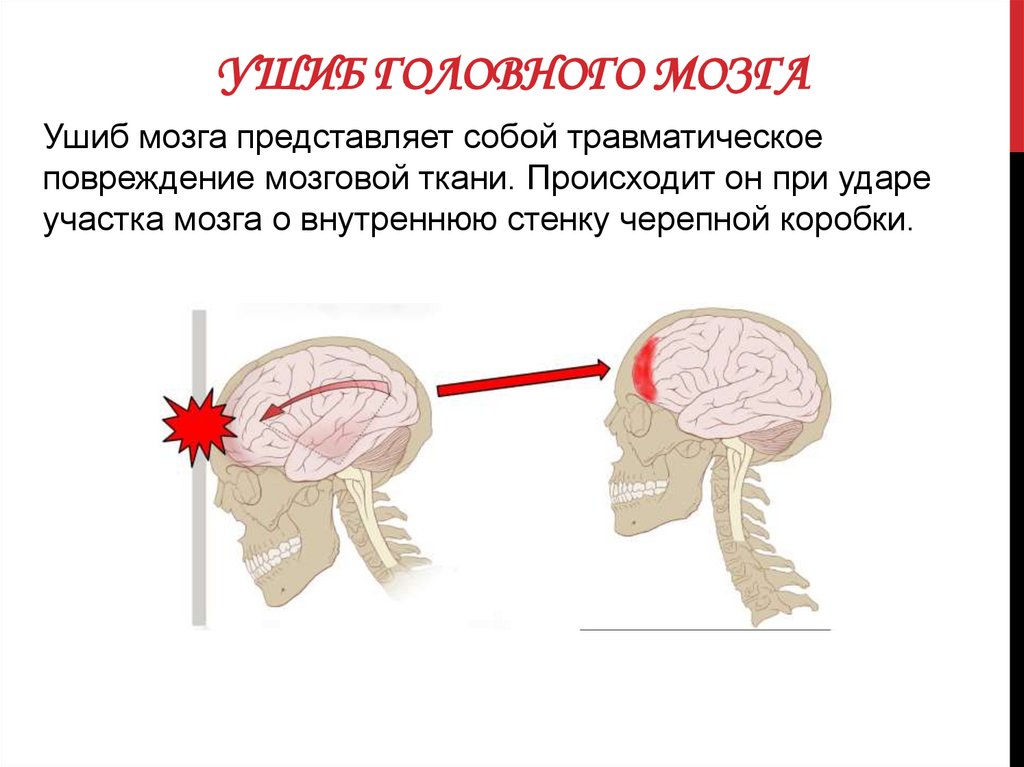 Сотрясение головного мозга карта вызова смп