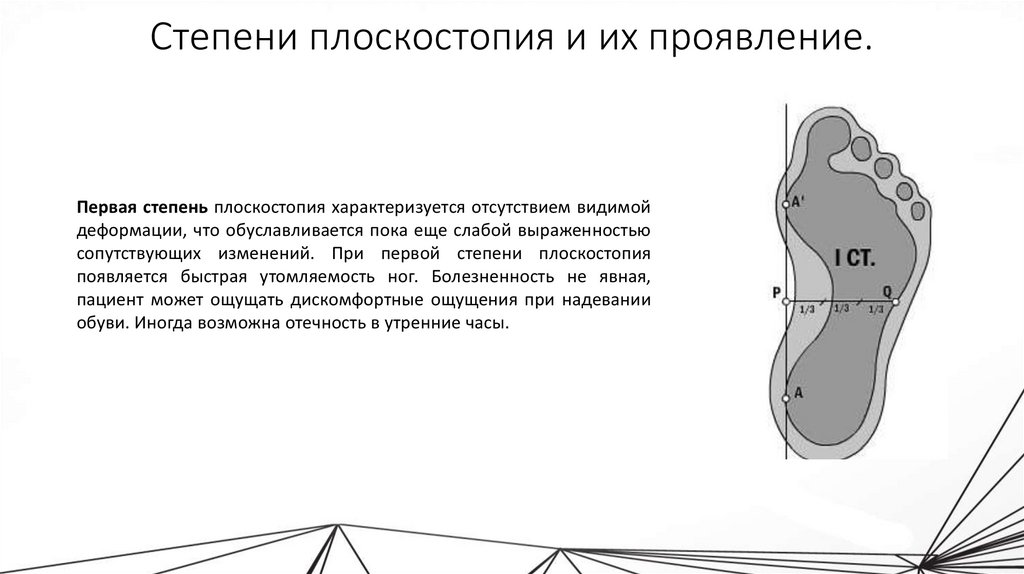 Плоскостопие с артрозом берут в армию. Диагноз плоскостопие 1 и 2 степень. Плоскостопие 2 степени и 3 степени. 2 Степень плоскостопия градусы. Продольное плоскостопие 2 степени категория годности.