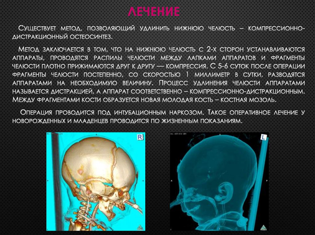 Синдром Пьера Робена - online presentation