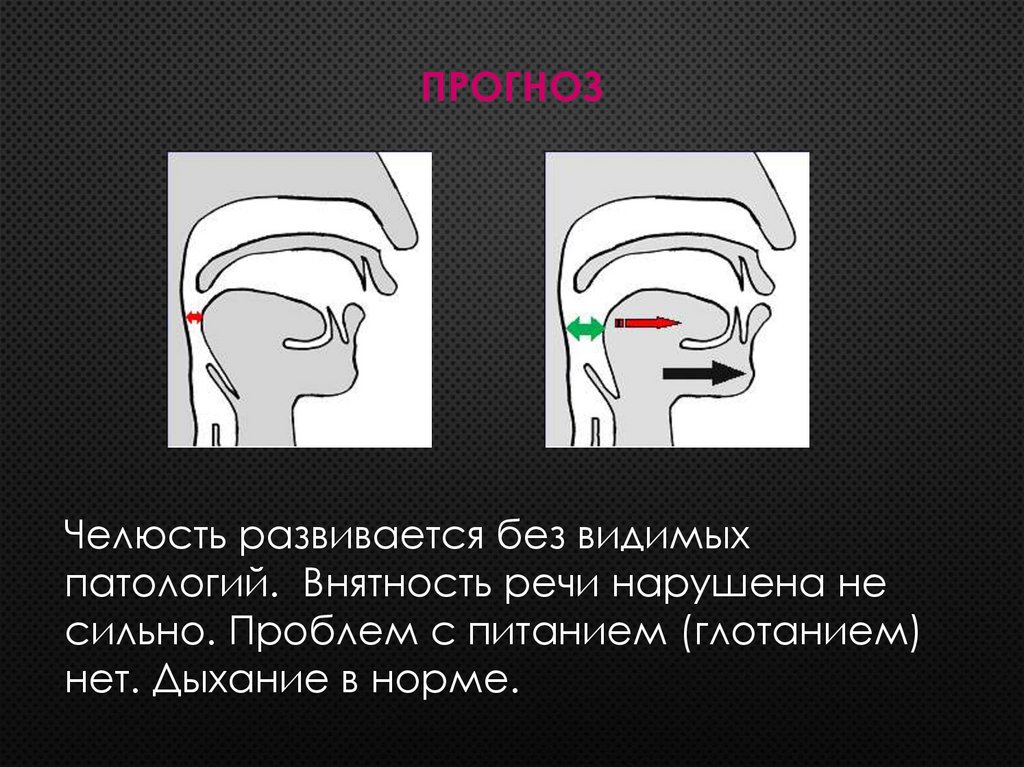 Синдром Пьера Робена - online presentation