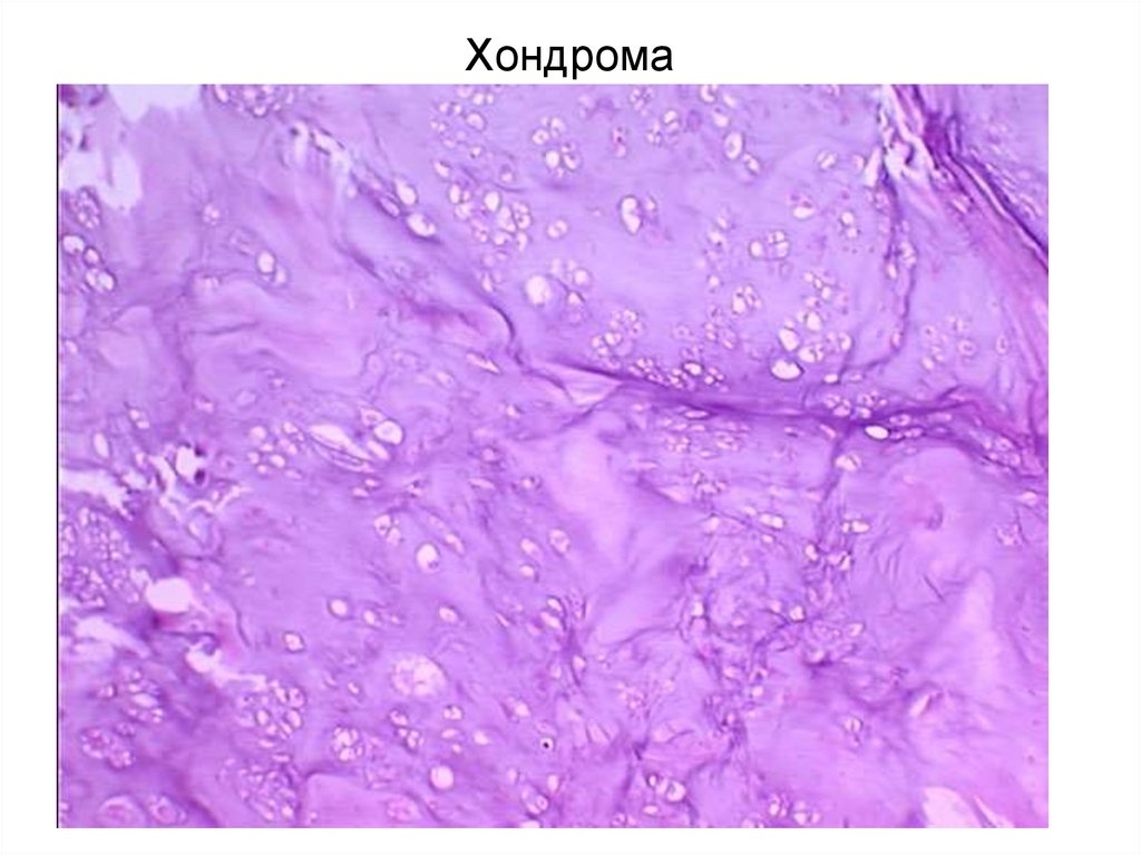 Хондрома микропрепарат рисунок