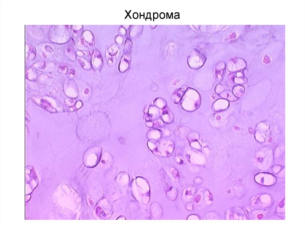 Хондрома микропрепарат рисунок
