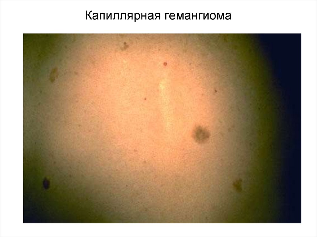 Злокачественные опухоли мезенхимального происхождения. Доброкачественная опухоль капилляров. Доброкачественная опухоль из капилляров. Плоская капиллярная опухоль у детей. Доброкачественные опухоли из капилляров сосудов. На спине.