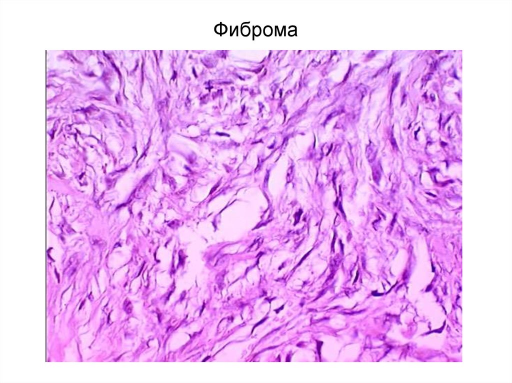 Мезенхимальные опухоли. Мезенхимальные опухоли микропрепараты. Мезенхимальные опухоли гистология. Мезенхимальные опухоли молочной железы. Мезенхимальная опухоль мягких тканей.
