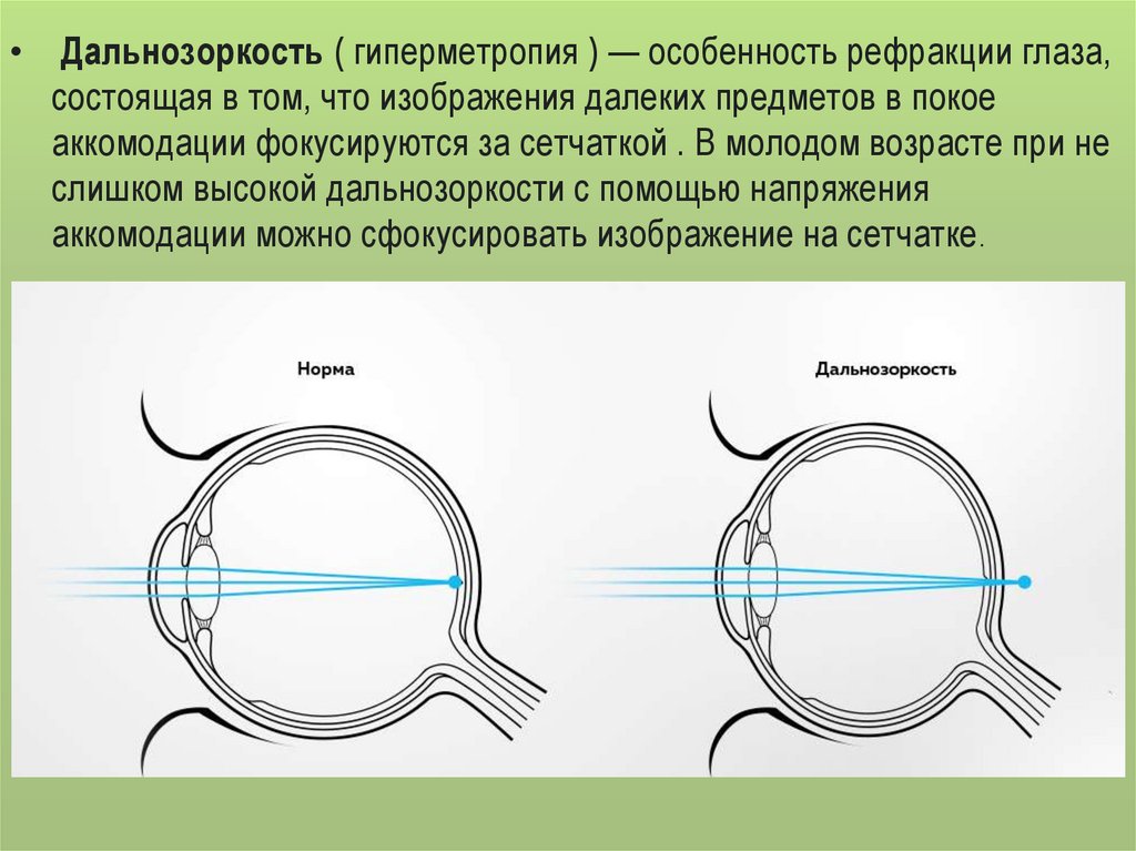 Гиперметропия средней степени глаза. Эмметропия миопия гиперметропия. Дальнозоркость рефракция. Рефракция глаза. Заболевание глаз гиперметропия.