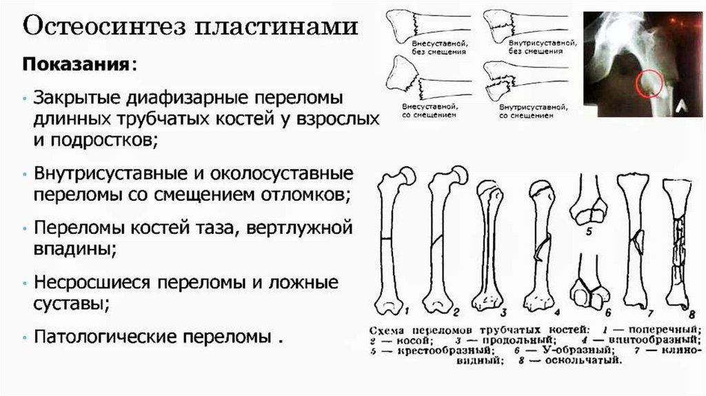 Карта вызова смп перелом бедренной кости