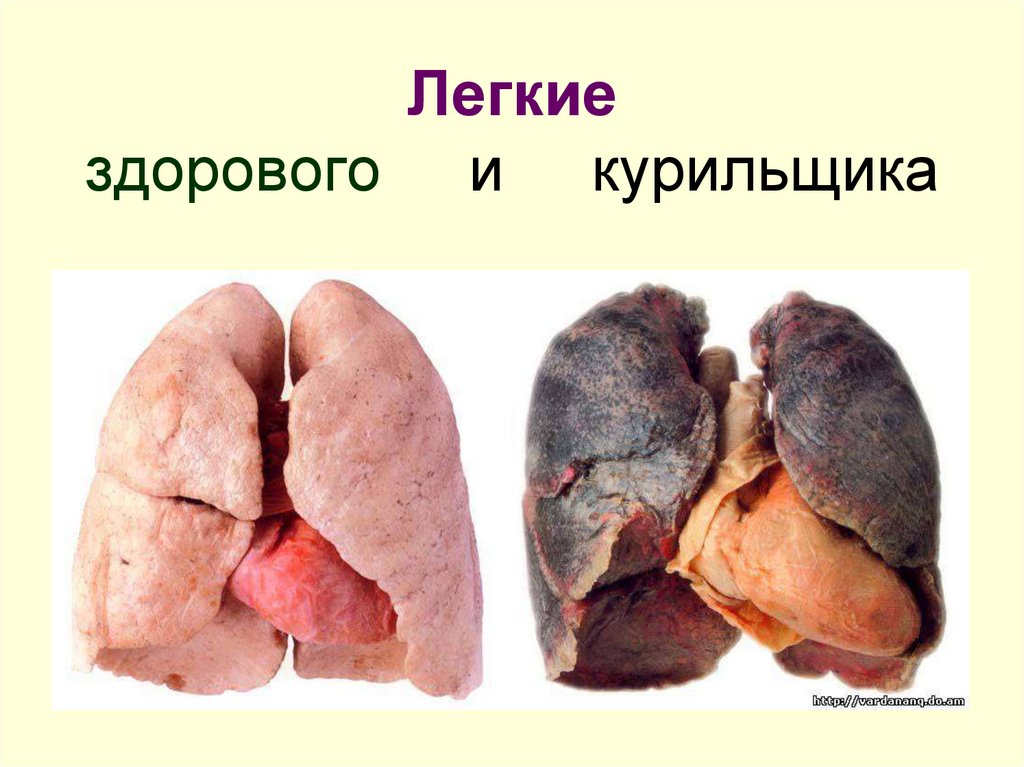 Легкие здорового и курильщика