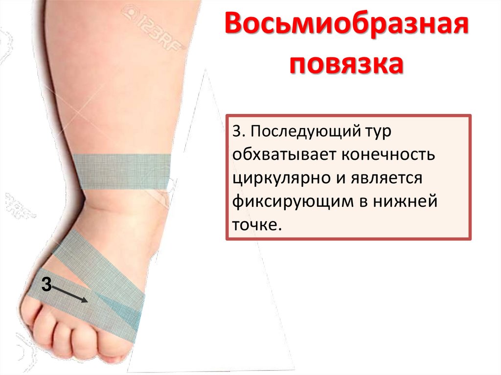 Отработка приемов по наложению крестообразной (восьмиобразной) повязки ...