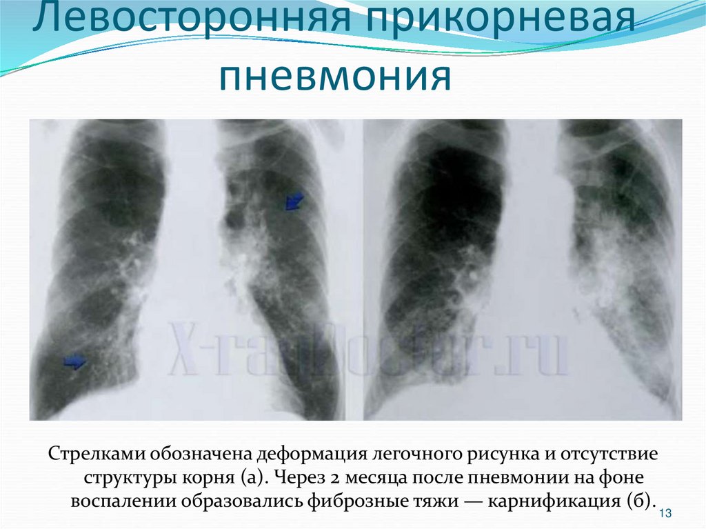 Верхнедолевая пневмония