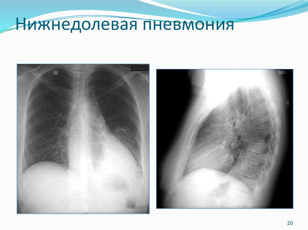 Верхнедолевая пневмония