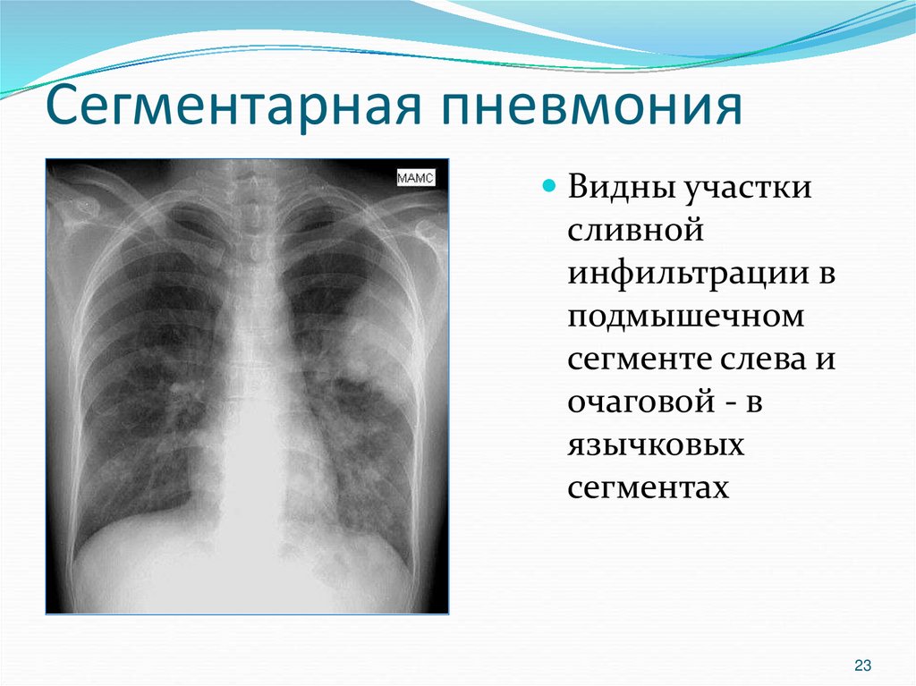 Пневмония 6. Очаговая тень в язычковых сегментах слева.