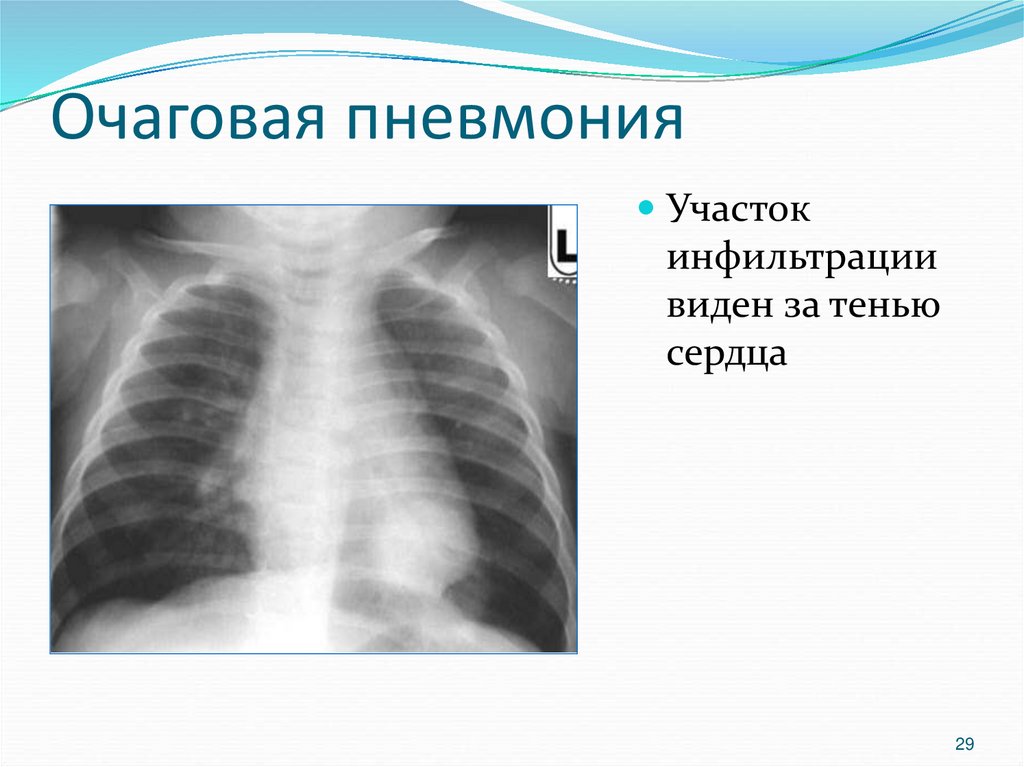 Очаговая пневмония