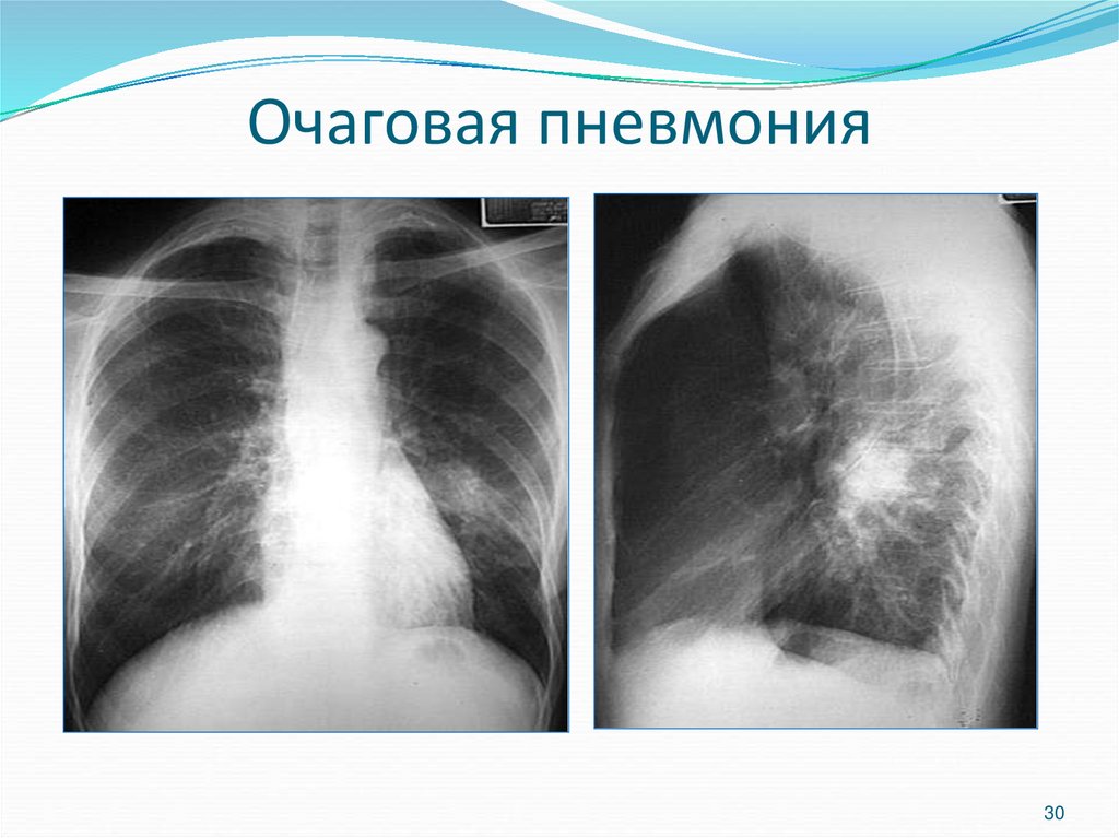 Особенности очаговой пневмонии