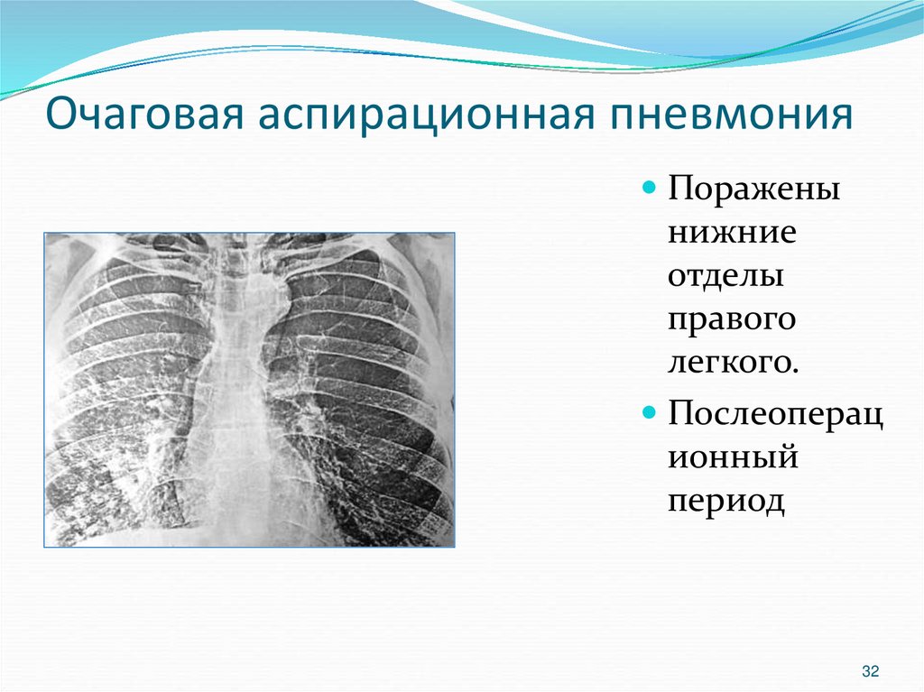 Пневмония очаговая презентация