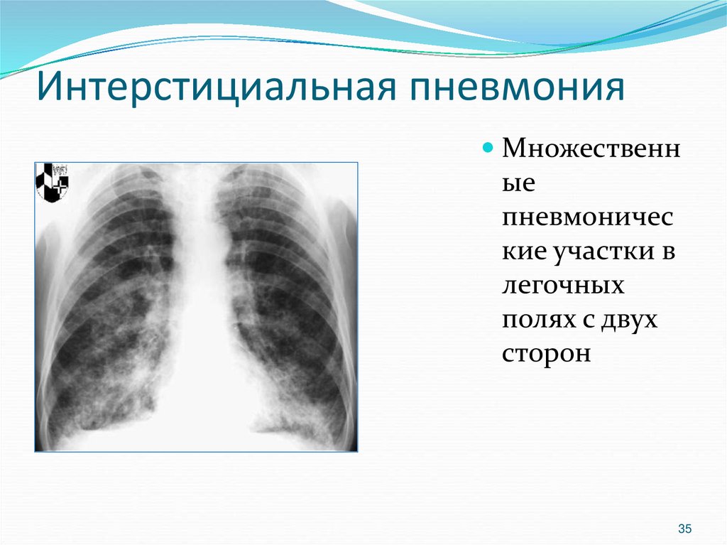 Легочный рисунок обогащен за счет интерстициального компонента что это значит