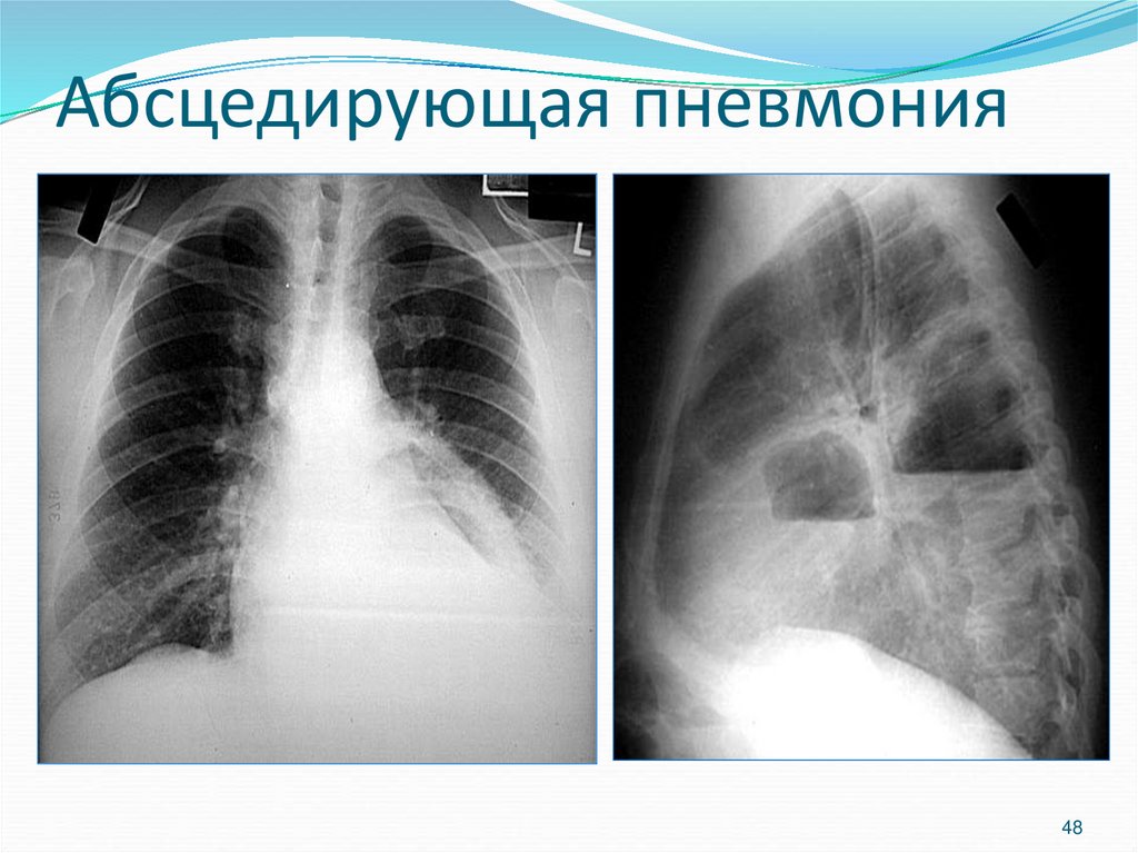 Абсцедирующая пневмония