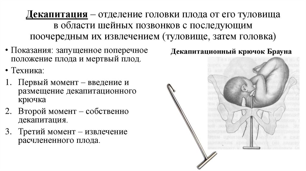 Вакуум экстракция плода презентация