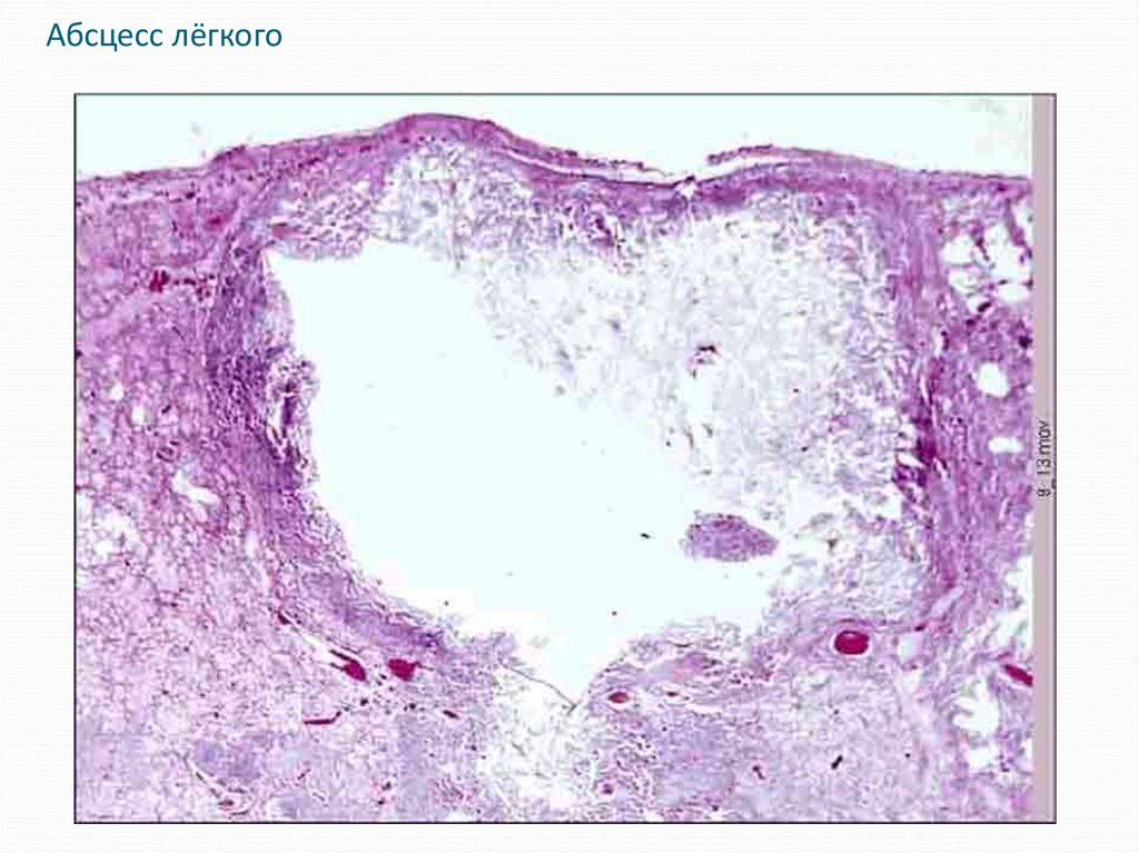 Макроскопическое изображение гемозидероза лёгких. 1 абсцесс легкого