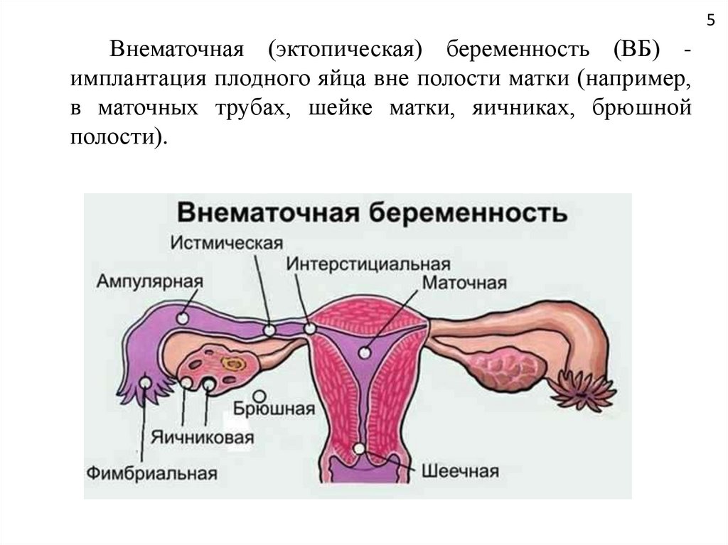 Эктопическая беременность презентация