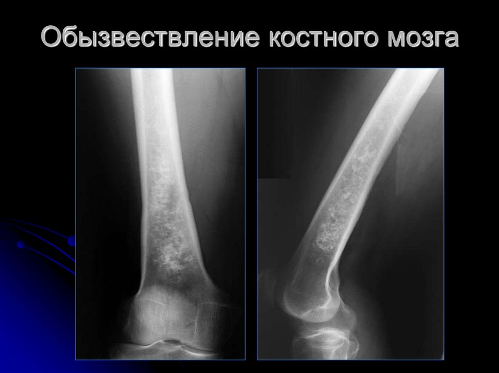 Обызвествление. Обызвествление костного мозга в бедренной кости рентген. Обызвествление костного мозга большеберцовой кости. Инфаркт костного мозга большеберцовой кости рентген. Обызвествление костного мозга плечевой кости.