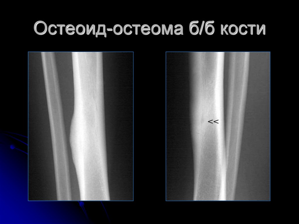 Опухоли лучевой кости. Остеома большеберцовой кости рентген. Остеоид-остеома бедренной кости рентген. Компактная остеома большеберцовой кости. Остеома бедренной кости рентген.