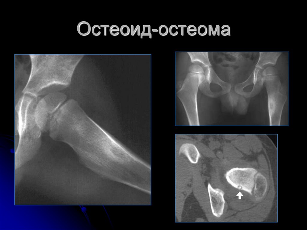 Остеоид остеома бедренной кости