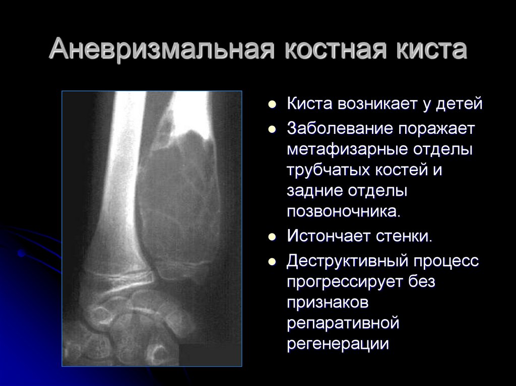 Операция кисты кости. Аневризматическая костная киста рентген. Солитарная костная киста бедренной кости. Солитарная киста бедренной кости рентген. Аневризматическая костная киста бедренной кости.