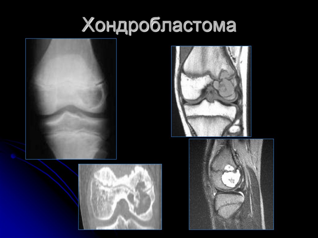 Хондробластома. Хондробластома бедренной кости кт. Опухоль кодмена хондробластома. Доброкачественная хондробластома.