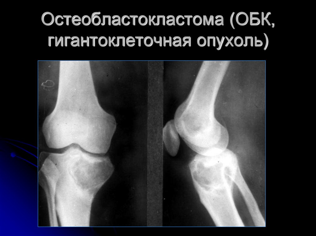 Диагностика опухоли кости. Остеобластокластома большеберцовой кости. Гигантоклеточная опухоль большеберцовой кости кт. Гигантоклеточная опухоль бедренной кости на кт. Гигантоклеточная опухоль большеберцовой кости рентген.