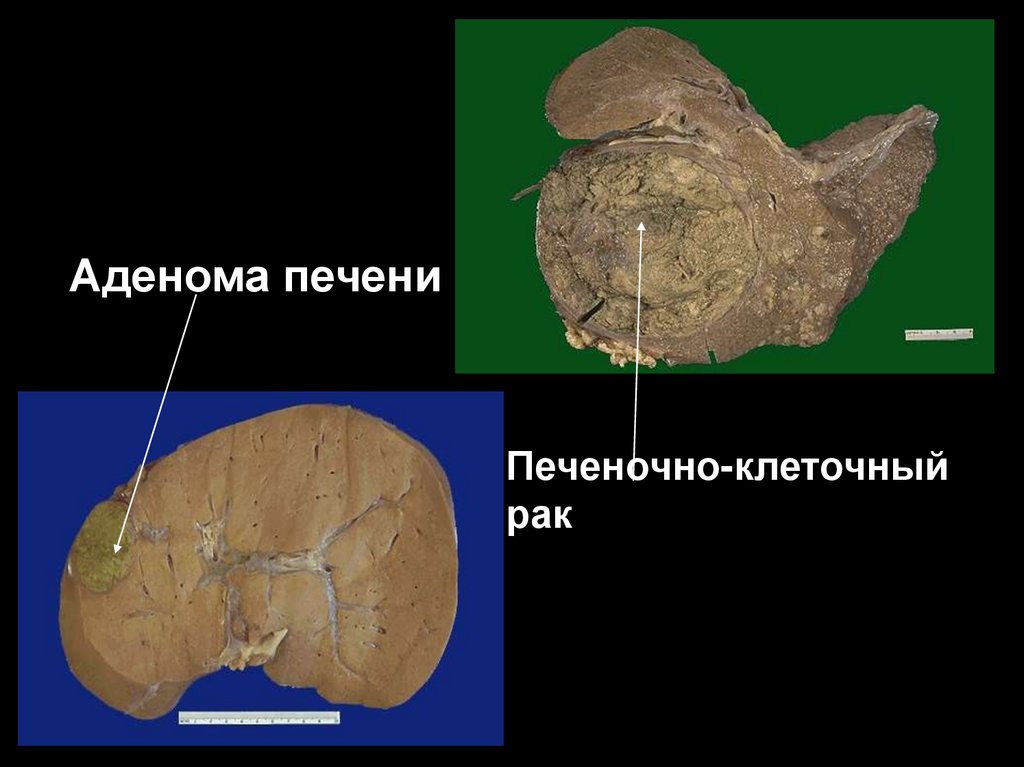 Печеночно клеточный