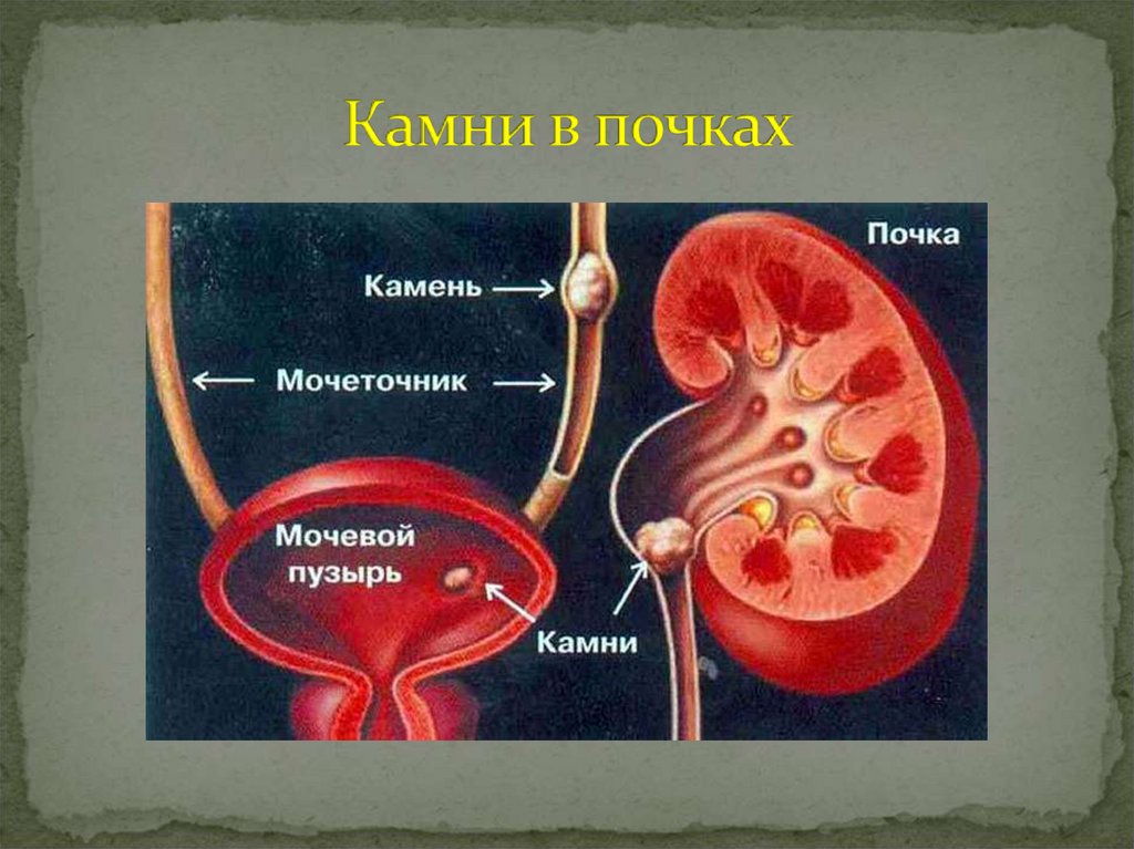 Камни в почках