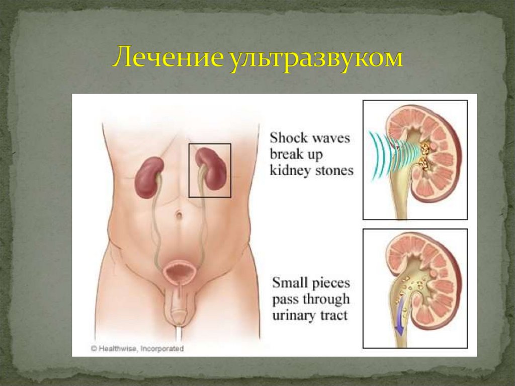 Лечение ультразвуком