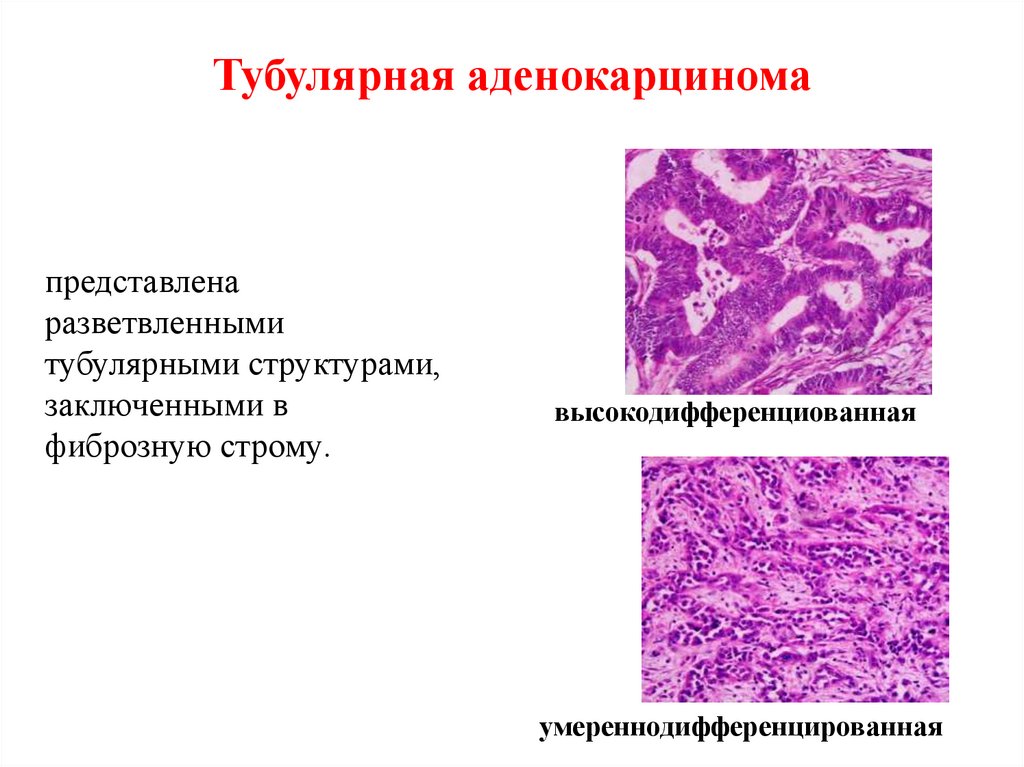 Аденокарцинома это