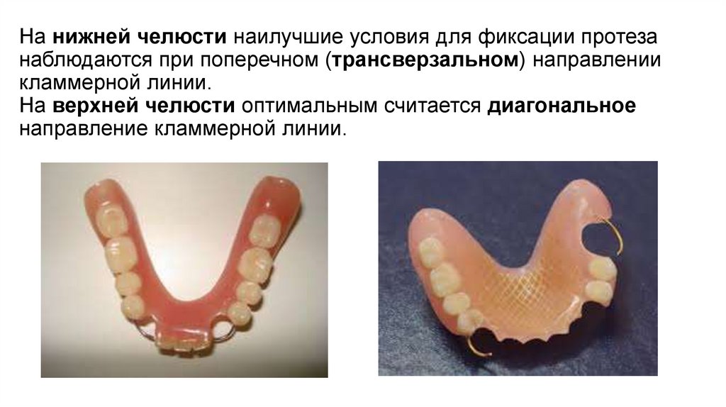 Полный съемный пластиночный протез презентация