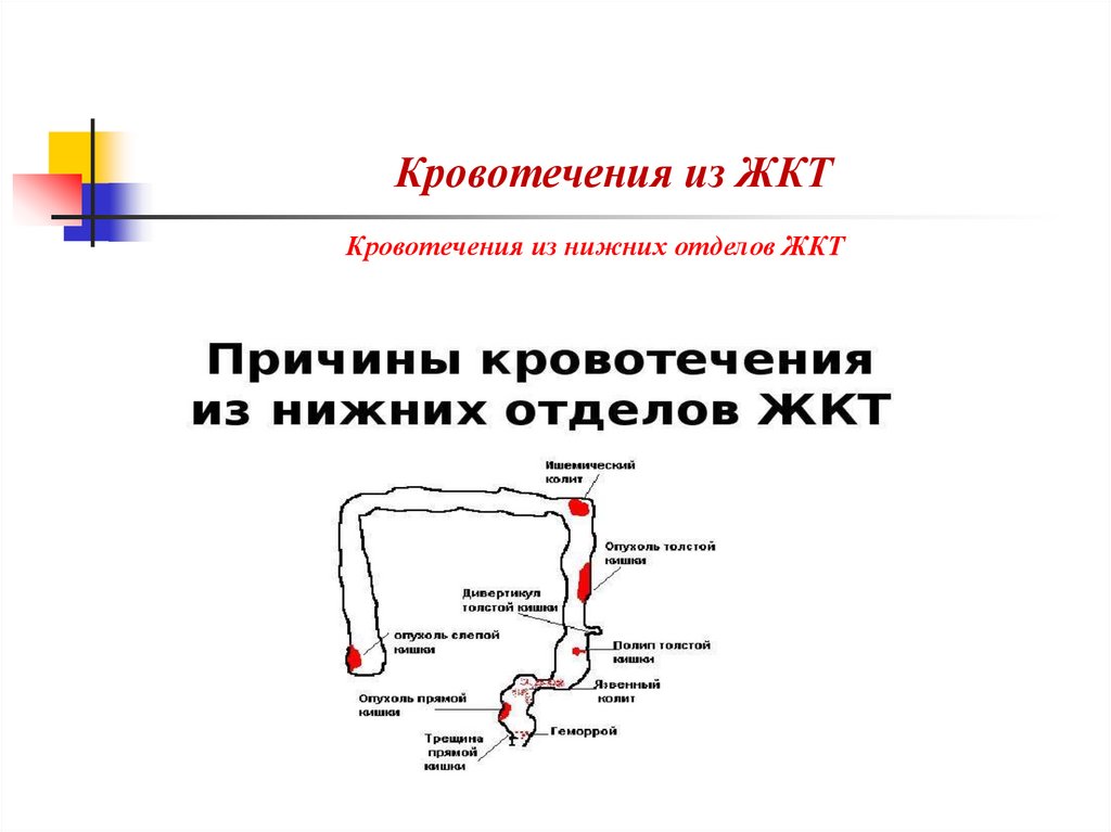 Кровотечение пищеварительного тракта