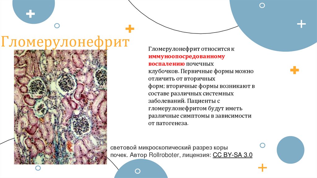 Гломерулонефрит