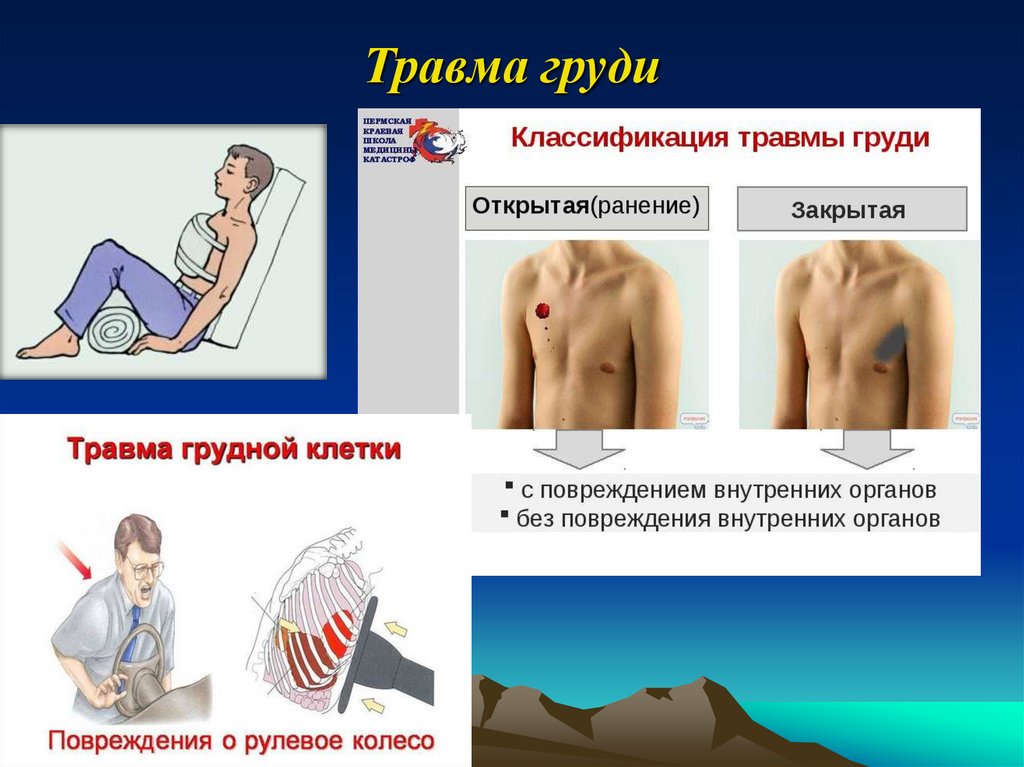 Открытые и закрытые травмы грудной клетки презентация