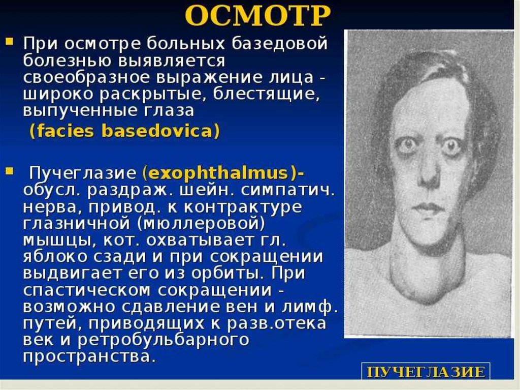 Базедова болезнь. Базедова болезнь это кратко. Базедова болезнь презентация.