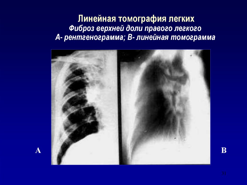 Фиброз нижних долей легких. Легочный фиброз на рентгене. Пневмофиброз томограмма. Рентгенография линейная томография. Линейная томограмма легких туберкулез.