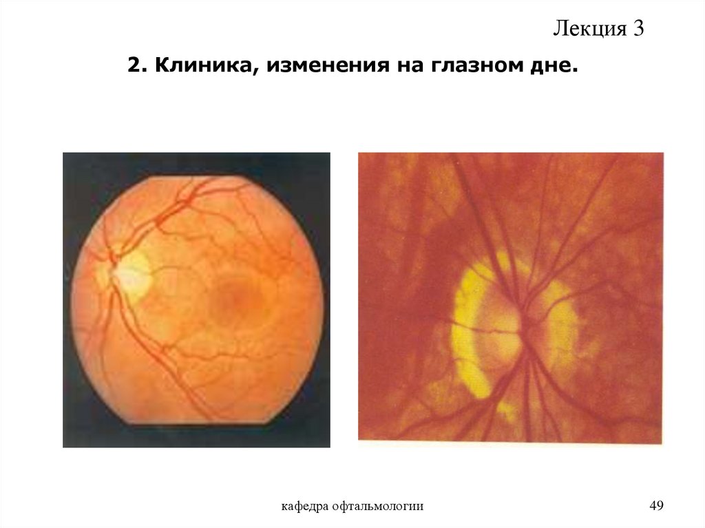 Изменение на глазном дне. Изменения на глазном дне. Перипапиллярная атрофия хориоидеи. Схема глазного дна. Средство для исследования глазного дна.