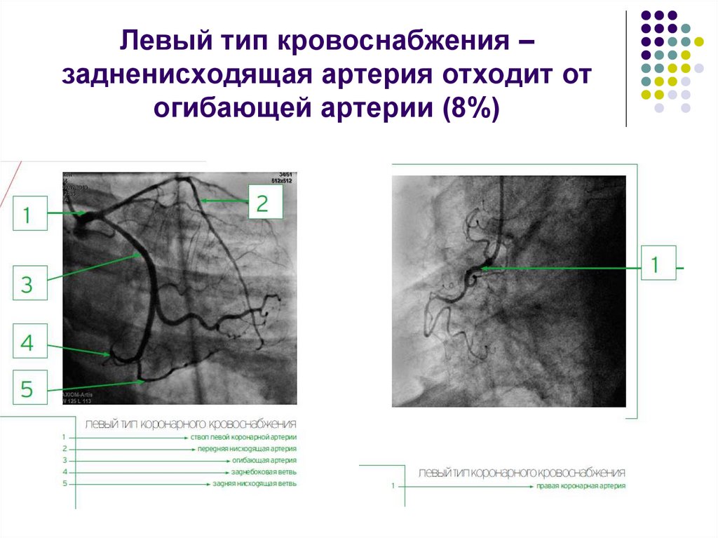 Левый вид. Типы кровоснабжения миокарда. Правый и левый Тип кровоснабжения сердца. Левый и правый Тип коронарного кровоснабжения. Правовенечный Тип кровоснабжения сердца.