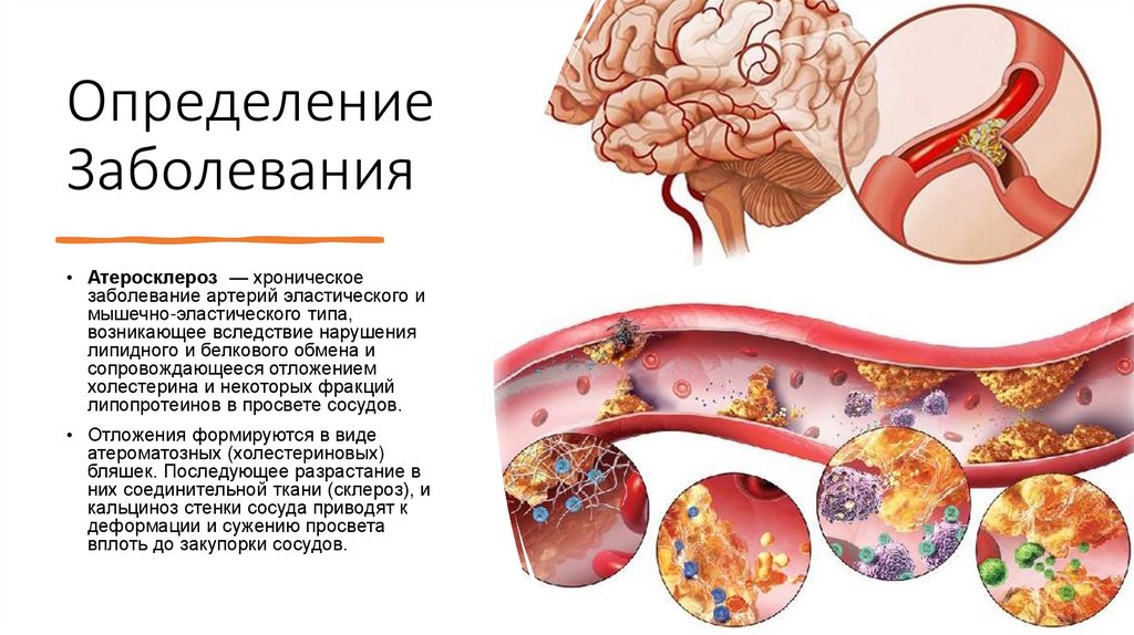 Пищевые растения при Атеросклерозе - online presentation