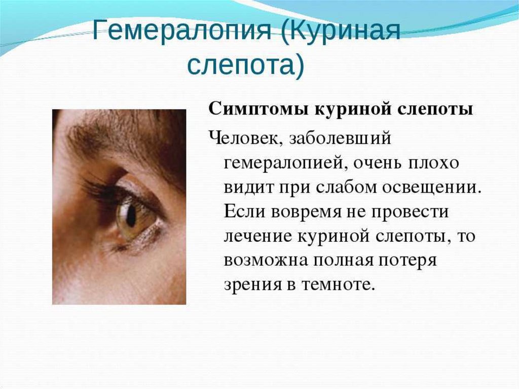 Заболевания органа глаза. Куриная слепота болезнь. Куриная слепота заболевание глаз. Симптомы куриной слепоты.