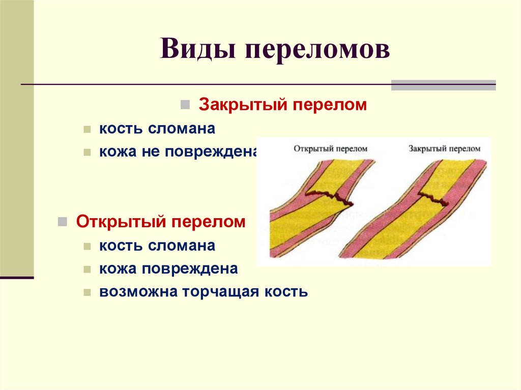 Виды переломов картинки