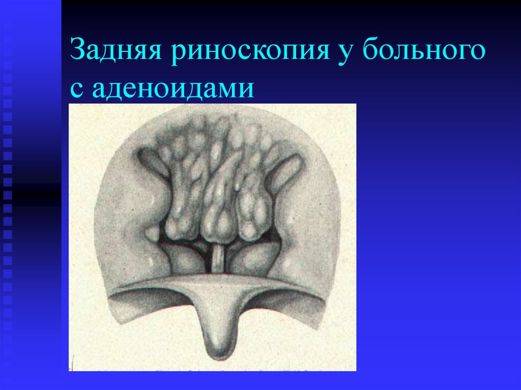 Задняя риноскопия у больного с аденоидами