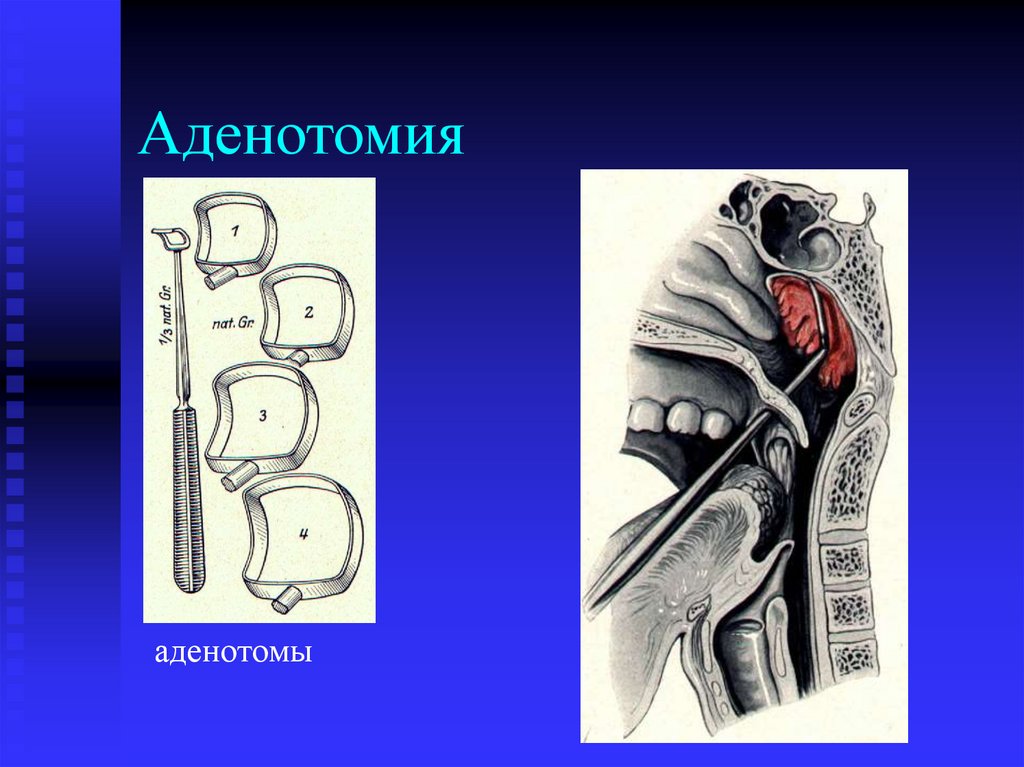 Аденотомия