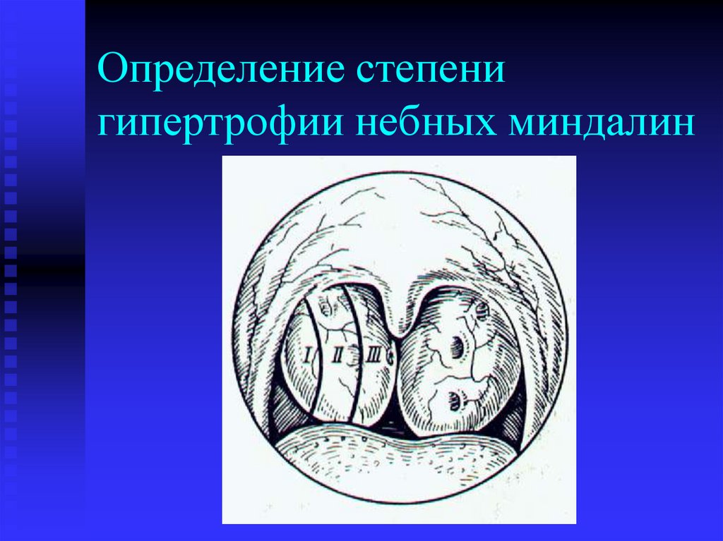 Определение степени гипертрофии небных миндалин