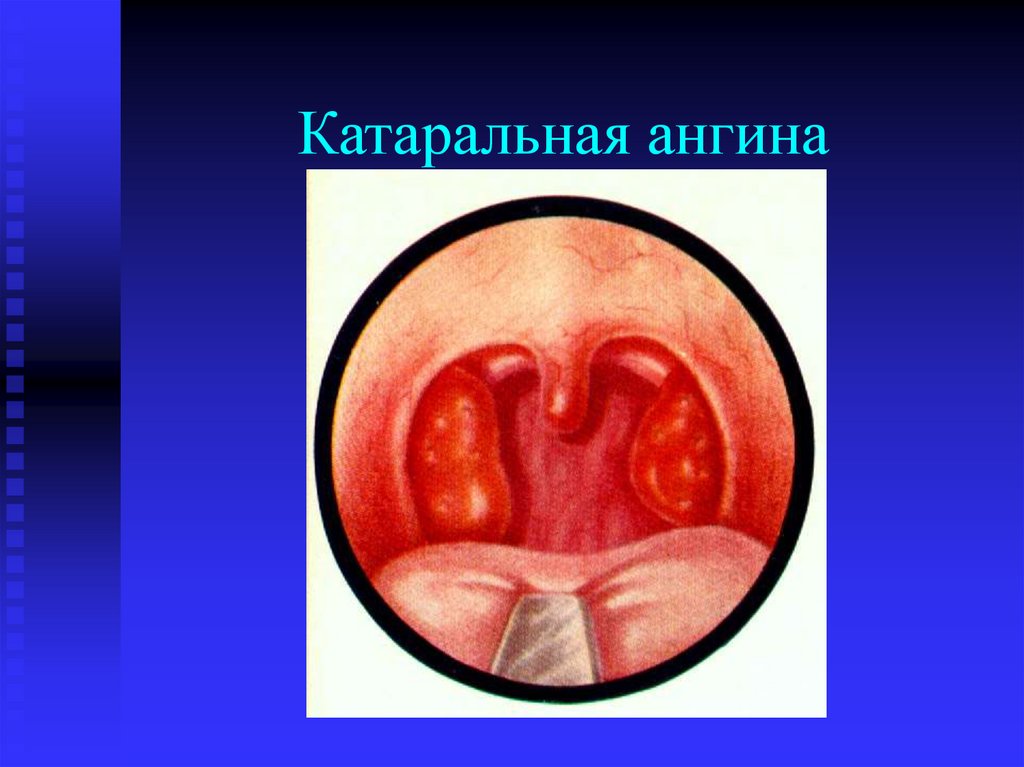 Катаральная ангина