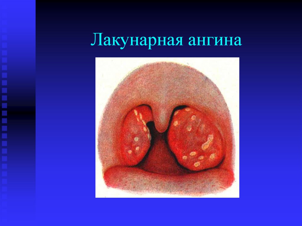 Лакунарная ангина